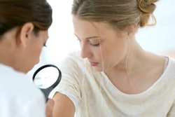 melanoma